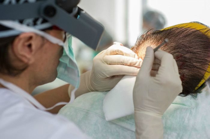 injerto de cabello en México - tricólogo realizando un injerto capilar a un hombre en la zona de la coronilla la cual esta muy despoblada de cabello