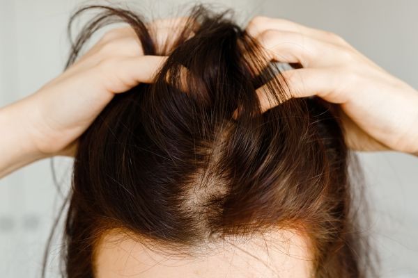 tipos de calvicie - mujer blanca mostrando los efectos de la alopecia areata en la parte frontal de su cabello