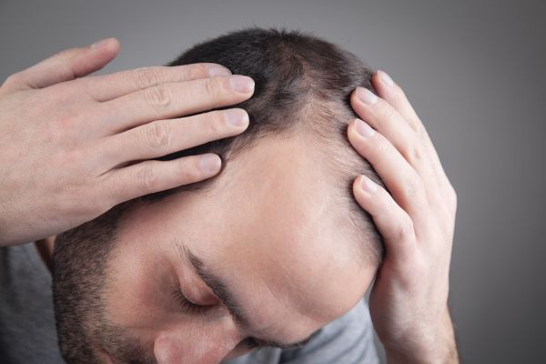 causas de la pérdida de cabello - imagen de un hombre blanco mostrando los problemas de alopecia que sufre en la zona de las entradas del cabello y la perdida de la densidad capilar en el area