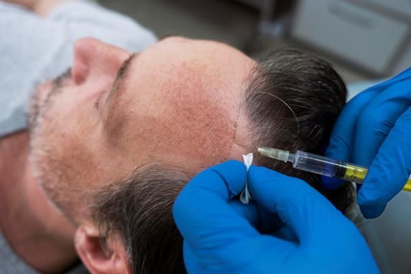 dudas más frecuentes del injerto capilar - paciente en la consulta del especialista recibiendo un tratamiento para la caída del cabello en forma de inyección en la zona de la entradas