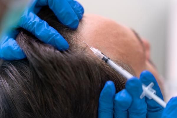 dudas más frecuentes del injerto capilar - paciente en la consulta del especialista recibiendo un tratamiento para la caída del cabello en forma de inyección en la zona de la entradas