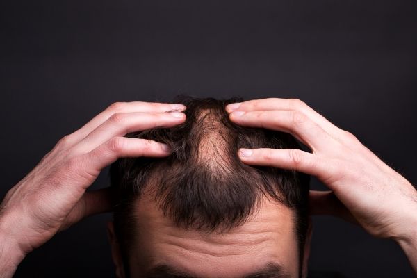 causas de la pérdida de cabello - hombre blanco con problemas de alopecia en la parte superior de la cabeza y en las entradas del cabello