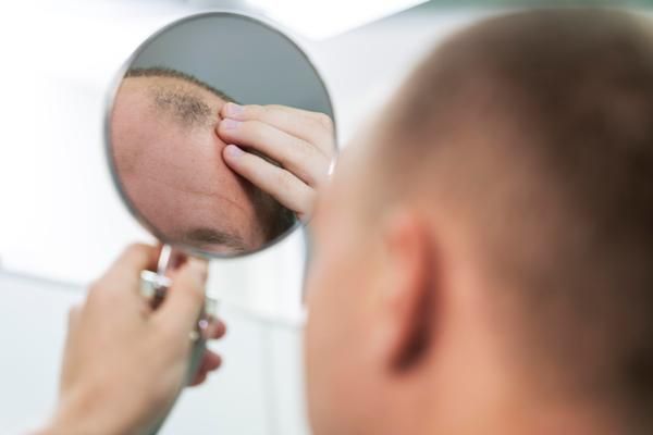 paciente en la consulta del tricólogo revisando en el espejo la zona de la cabeza donde la alopecia ha causado estragos  