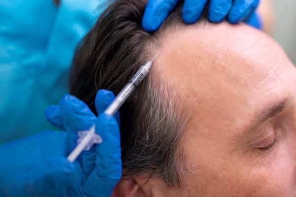 hombre blanco recibiendo un tratamiento capilar en forma de inyección para la mejora de su salud capilar