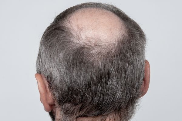 tipos de calvicie - imagen de la parte posterior de la cabeza de un hombre con un problema de alopecia en la zona de la coronilla