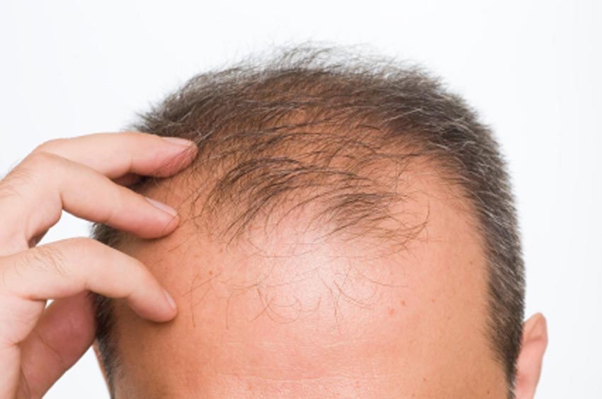 Edad para hacer injerto de cabello - imagen de la parte superior de la cabeza de un hombre con problema de alopecia en las entradas del cabello y la perdida de densidad en la zona superior