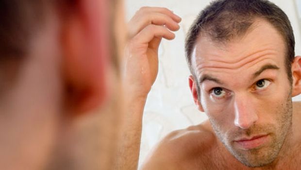 causas de la pérdida de cabello - hombre blanco en el espejo con un claro avance de la alopecia en la zona de las sienes y la línea del cabello