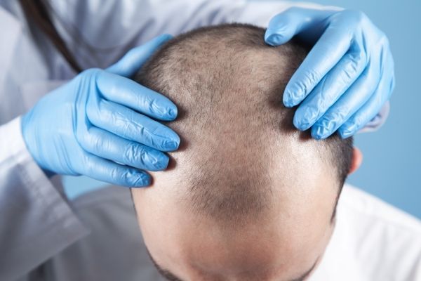 Edad para hacer injerto de cabello - tricóloga estudiando el tipo y grado de alopecia en el cabello de un hombre adulto