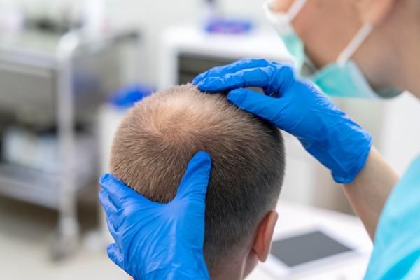 Dormir después del injerto de cabello - Dermatóloga especializada en tricología evalúa el cuero cabelludo de un paciente con problemas de alopecia