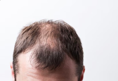 famosos con injerto cabello CDMX- hombre con alopecia