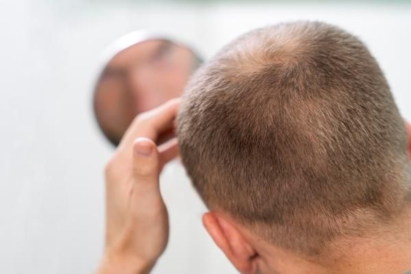 Edad para hacer injerto de cabello - hombre adulto de espaldas mirando en un espejo los efectos de la alopecia en su línea del cabello