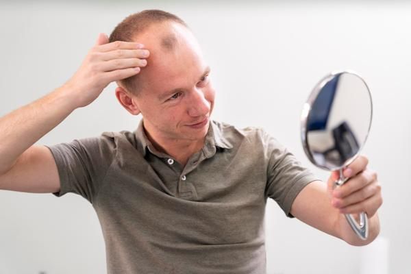 Injerto de cabello 10 años después - hombre blanco revisando en un espejo los efectos de la alopecia en su cabeza
