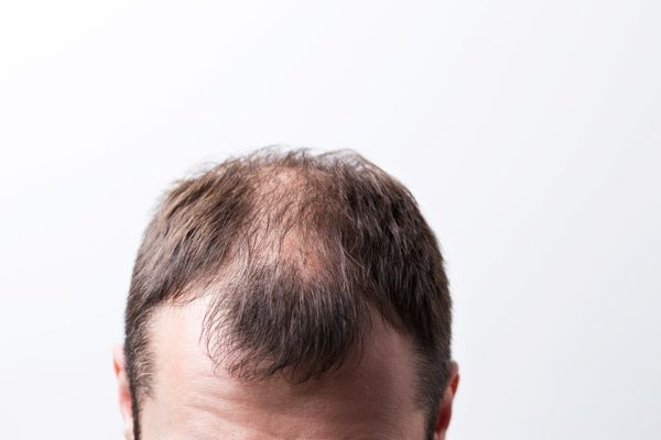 Injerto de cabello 10 años después - imagen de la parte superior de la cabeza de u hombre blanco con problemas de alopecia