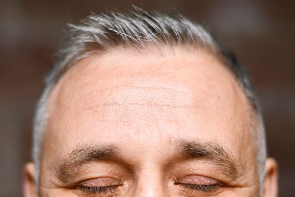 Injerto de cabello 10 años después - hombre adulto con el cabello corto y canoso y la línea de la frente en retroceso