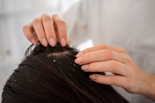 Foliculitis - Especialista examinando el cuero cabelludo de una paciente femenina, la cual presenta escamas y picazón entre los síntomas de la foliculitis