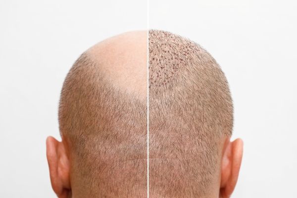 Injerto capilar infectado - Imagen comparativa de la evolución de un implante de cabello, el cual permite revertir los efectos de la alopecia