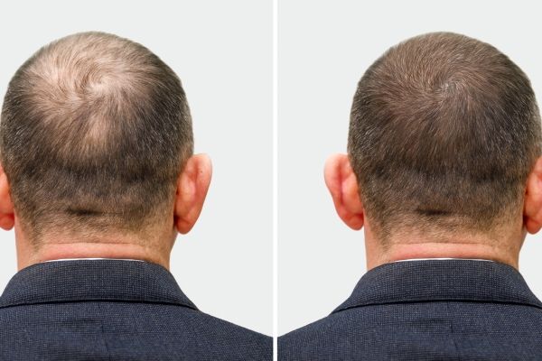 Imagen comparativa de un implante de cabello, el cual permite recuperar el pelo natural en las zonas con alopecia