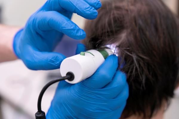 Médico evaluando la evolución del implante de cabello, observando la caída y pérdida de los folículos implantados debido al rozamiento