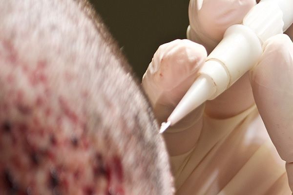 Injerto capilar sin rapar la cabeza - Médico especialista realizando un implante de cabello a un paciente masculino, utilizando el método DHI con el instrumento llamado pluma Choi