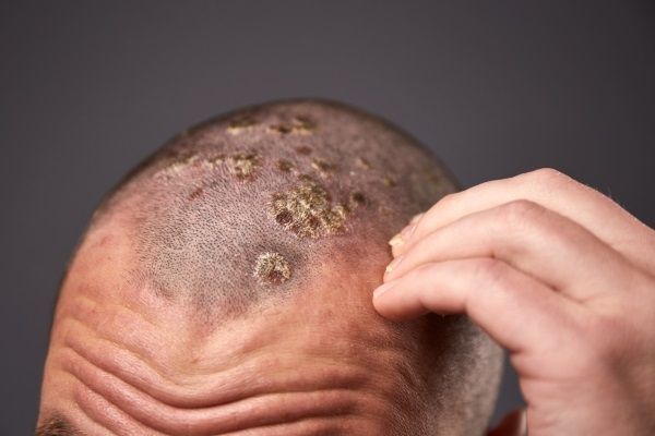 Injerto capilar infectado - Hombre con una infección en el cuero cabelludo, luego del procedimiento de implante capilar