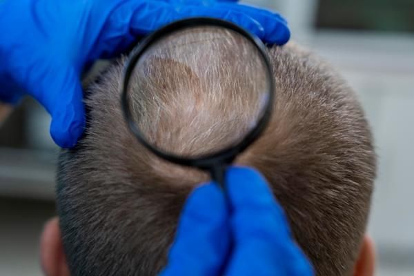 Injerto capilar infectado - Médico evaluando la evolución del implante de cabello, para asegurarse de que todo marcha correctamente