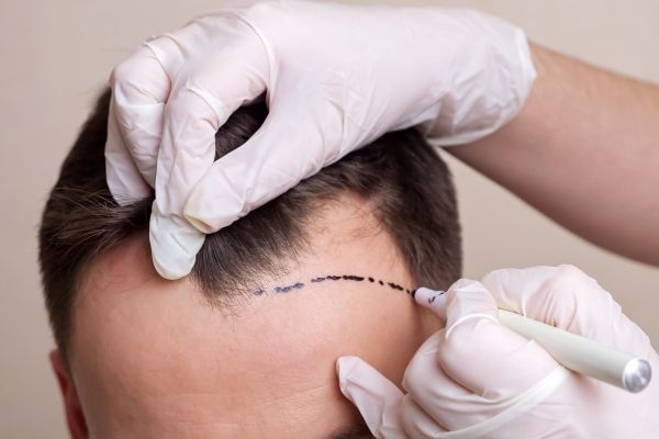 Médico especialista realizando el boceto del implante de cabello a un paciente masculino, para determinar la cantidad de folículos que se necesitan injertar utilizando el método DHI