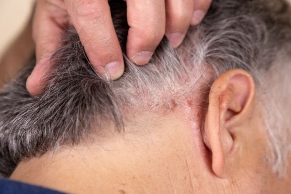 Hombre con edemas en las zonas donde se extrajeron los folículos pilosos, como consecuencia de realizarse un implante de cabello con médicos inexpertos