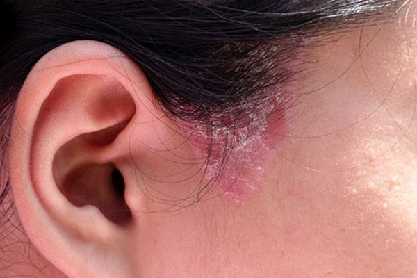 Enfermedades comunes del cuero cabelludo - imagen de la línea de cabello de la zona de la oreja de una mujer con síntomas de dermatitis seborreica en la zona de las patillas