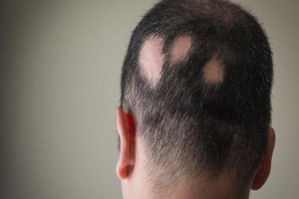Enfermedades comunes del cuero cabelludo - imagen de la cabeza de una mujer con los síntomas característicos de la esclerodermia en su cuero cabelludo