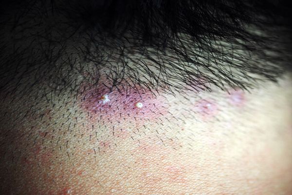 Enfermedades comunes del cuero cabelludo - imagen de la línea de cabello de un hombre con los granitos de pus característicos de la foliculitis