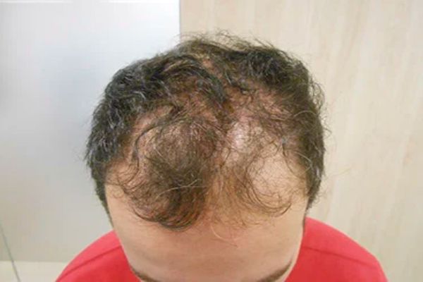 Enfermedades comunes del cuero cabelludo - imagen de la parte superior de la cabeza de un hombre con signos evidentes de perdida de cabello
