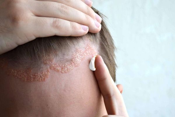 pica la cabeza - joven aplicando una crema para tratar la psoriasis en la línea del cabello de la frente