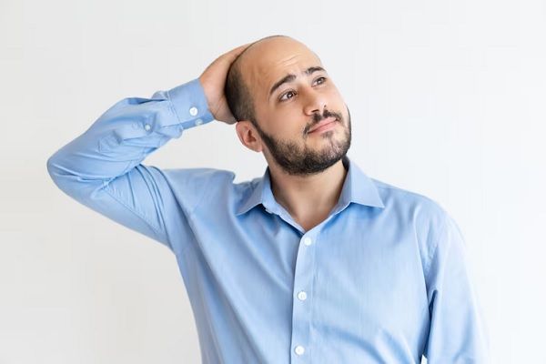 entradas en el cabello - hombre con camisa azul pasando la mano por la parte superior dela cabeza donde ha perdido gran parte de su cabello