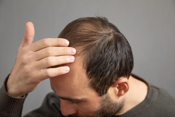 Enfermedades comunes del cuero cabelludo - hombre pasando su mano por la cabeza comprobando el efecto de la alopecia en su cabello