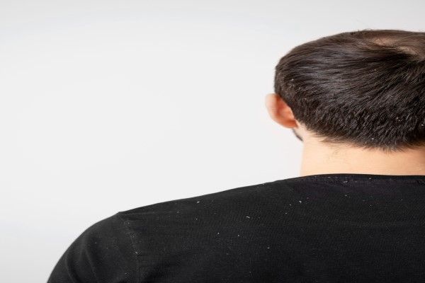 Causas de la caspa - Hombre de espaldas con escamas de caspa en la cabeza y la ropa