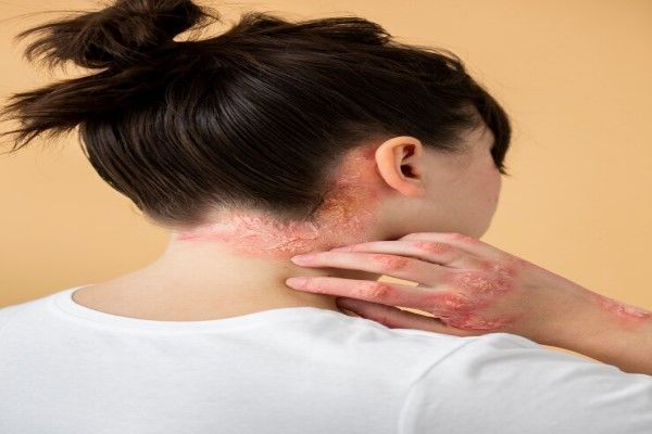 Causas de la caspa - mujer de espaldas con signos agudos de psoriasis en la mano y brazo derecho y en la línea del cabello