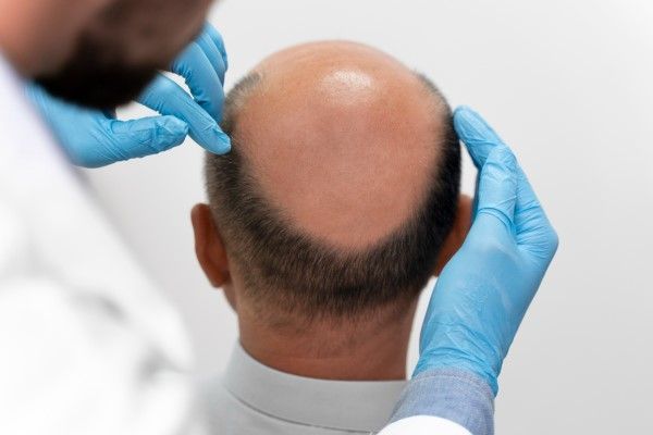 Coronilla despoblada - Médico especialista realizando un diagnóstico a la alopecia en la coronilla de un paciente masculino, para determinar el tratamiento más adecuado que permita recuperar su cabello natural