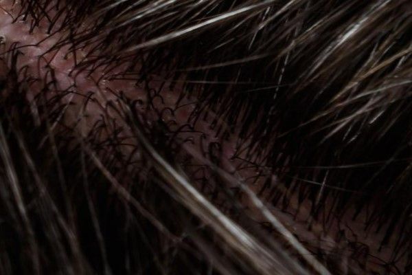 dormir con el pelo mojado - imagen del cuero cabelludo inflamado