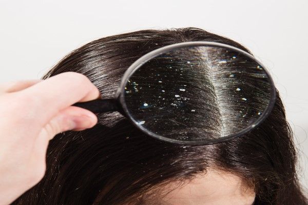 hombre colocando una lupa sobre el cabello de una mujer para ver mejor los síntomas de la enfermedad