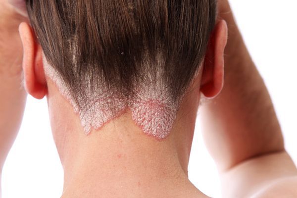 duele el cabello - mujer mostrando la parte de la línea del cabello de la zona de la nuca afectada por psoriasis