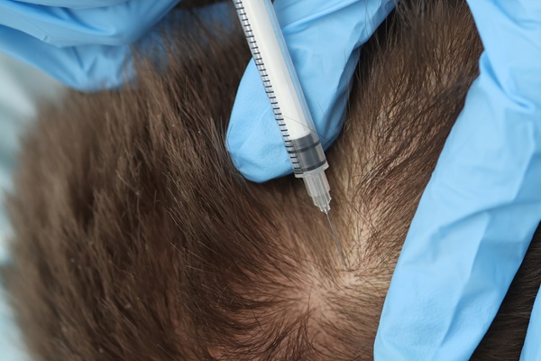 Médico especialista realizando un implante de cabello a un hombre con alopecia, para devolverle la densidad capilar en las zonas afectadas