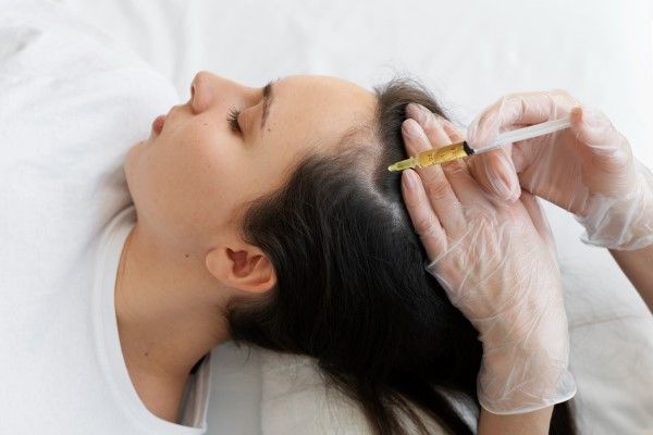 Dermatóloga aplica una serie de microinyecciones en el cuero cabelludo de una paciente como parte de un tratamiento de mesoterapia capilar para disimular las entradas 