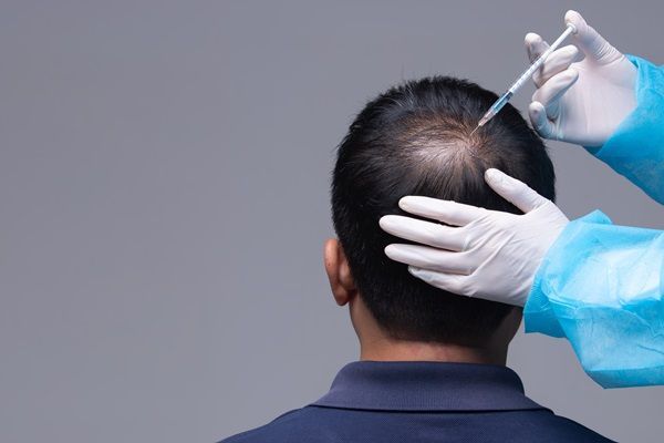 Zona donante - Doctor realizando un implante de cabello a un hombre en la zona de la coronilla