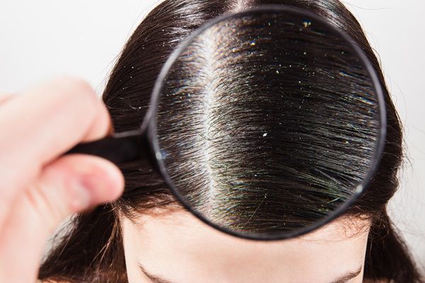 Keratina para el pelo - Mujer con alergia en el cuero cabello debido al tratamiento de keratina