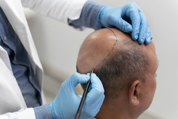 Zona donante - Doctor diseñando la zona receptora del paciente para el trasplante de cabello