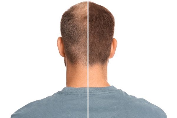 Evolución de un hombre al pasar varias semanas desde que se realizó el injerto capilar