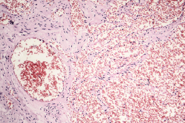 Hemangioma capilar sintomas - Vista microscópica de las células de la piel ante la formación de un hemangioma 