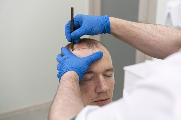Tricopigmentación capilar - Doctor realizando el dibujo guía para hacer el tratamiento de micropigmentación en el paciente
