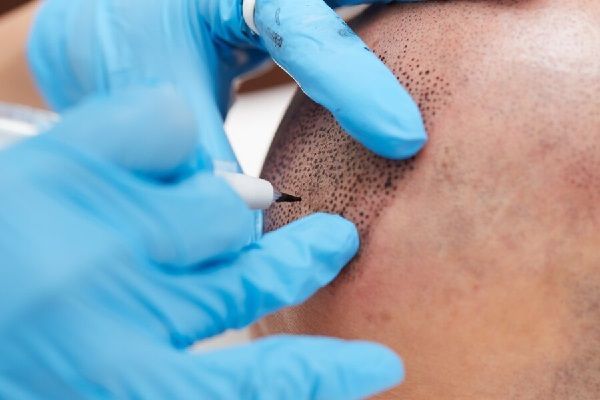 Tricopigmentación capilar - Doctor realizando el tratamiento de micropigmentación en el paciente