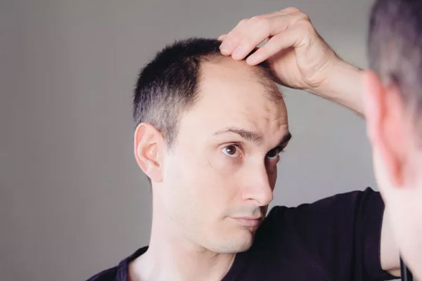 Testosterona y caída del cabello - Caballero examina con detenimiento las zonas de cuero cabello que han quedado desprovista de pelo